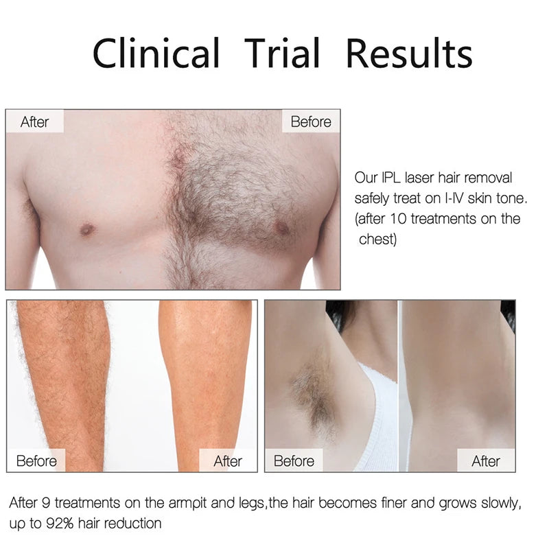 SkinPure™ IPL Laser Hair Removal Device